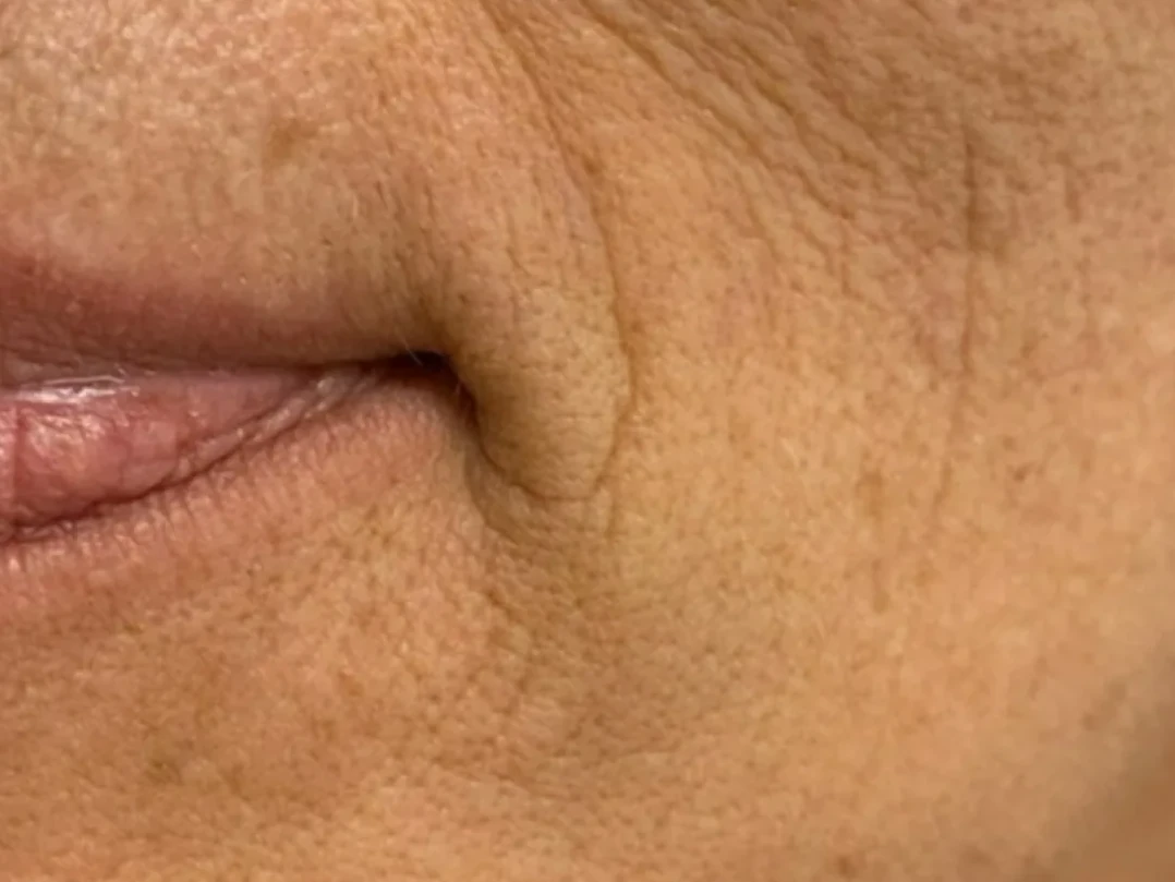 The skin around the lips before the treatment
