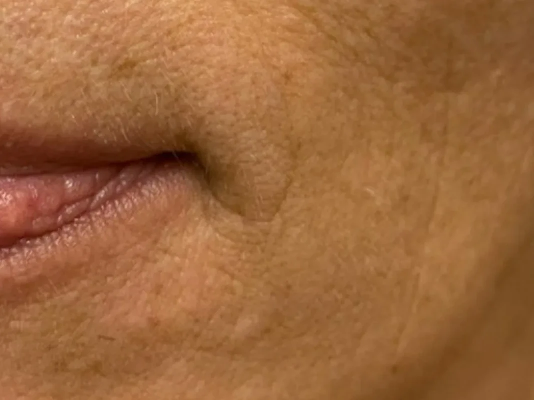 The skin around the lips after a treatment at Denny Divine